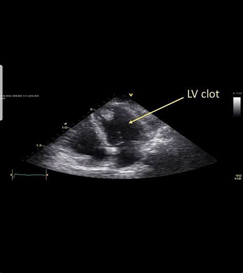 lv apical clot|anticoagulation for left ventricular thrombus.